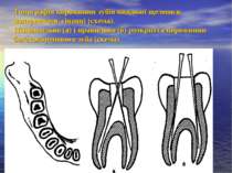 Топографія порожнини зубів нижньої щелепи в поперечному січенні (схема). Непр...