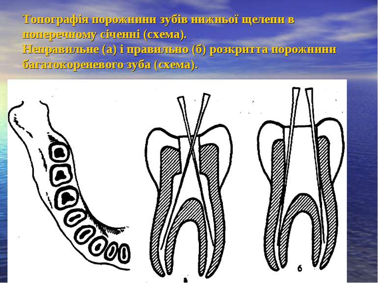 Топографія порожнини зубів нижньої щелепи в поперечному січенні (схема). Непр...