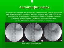 Ангіографія нирок Візуалізується масивне артеріовенозне скидання зліва з різк...