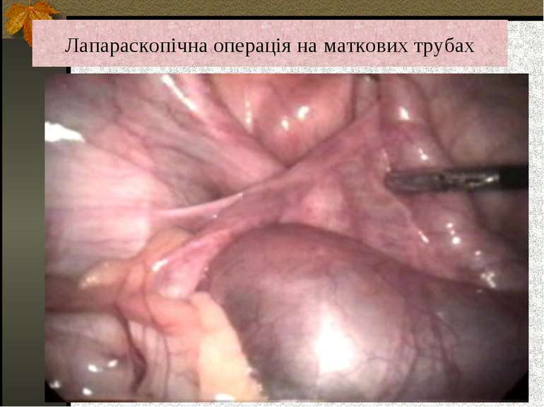 Лапараскопічна операція на маткових трубах