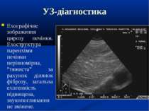 УЗ-діагностика Ехографічне зображення цирозу печінки. Ехоструктура паренхіми ...
