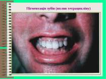 Пігментація зубів (вплив тетрацикліну)