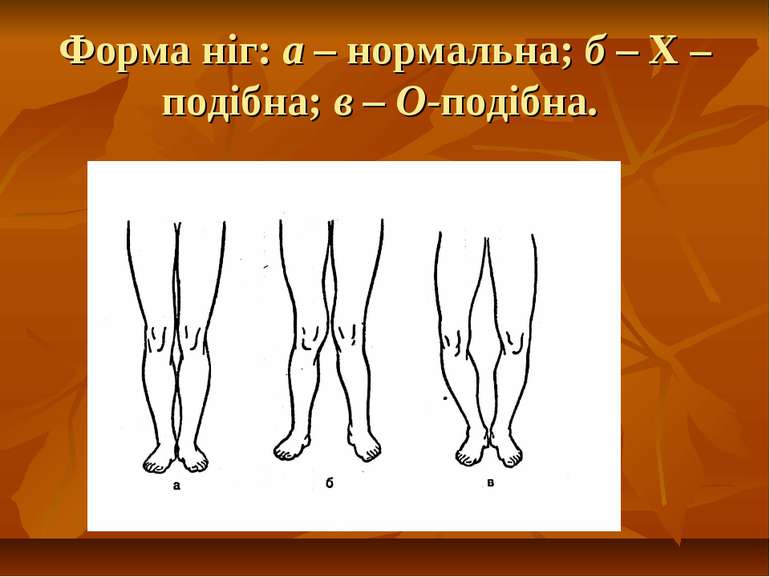 Форма ніг: а – нормальна; б – Х – подібна; в – О-подібна.