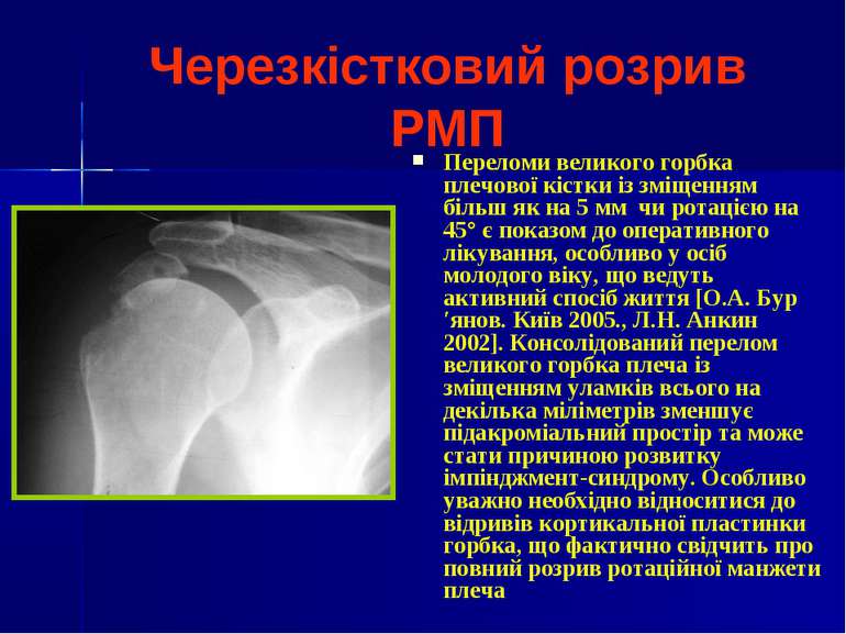 Черезкістковий розрив РМП Переломи великого горбка плечової кістки із зміщенн...