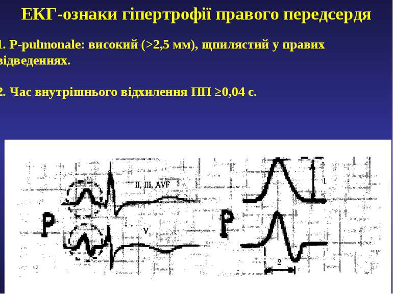 ЕКГ-ознаки гіпертрофії правого передсердя 1. P-pulmonale: високий (>2,5 мм), ...