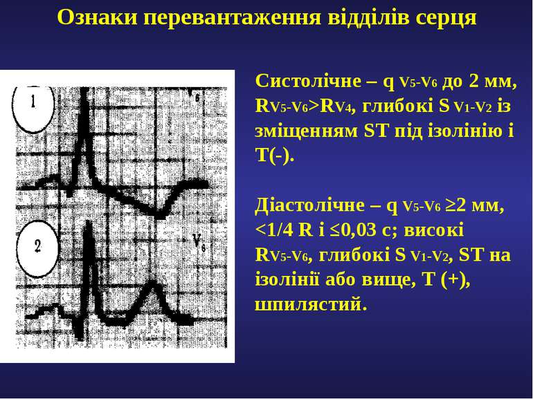 Ознаки перевантаження відділів серця Систолічне – q V5-V6 до 2 мм, RV5-V6>RV4...