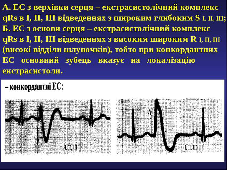 А. ЕС з верхівки серця – екстрасистолічний комплекс qRs в І, ІІ, ІІІ відведен...