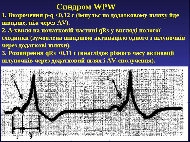 Cиндром WPW 1. Вкорочення p-q 0,11 с (внаслідок різного часу активації шлуноч...