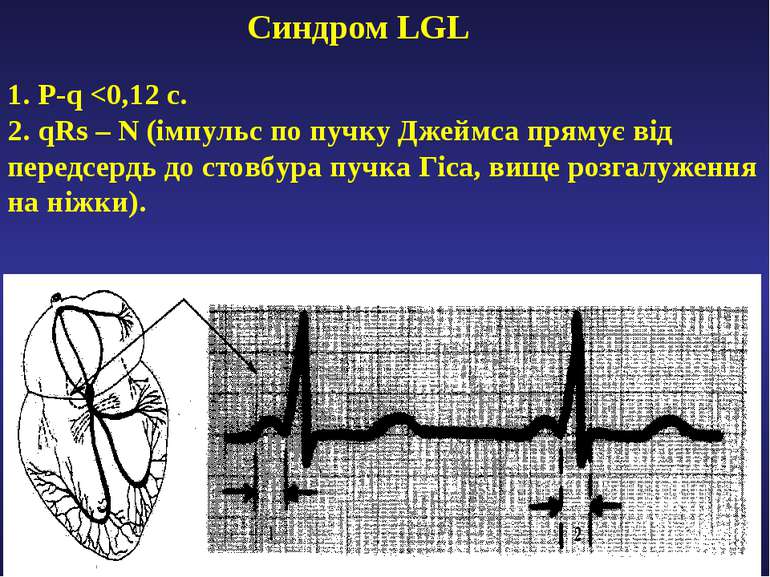 Синдром LGL 1. P-q