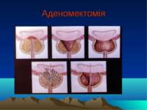 Аденомектомія