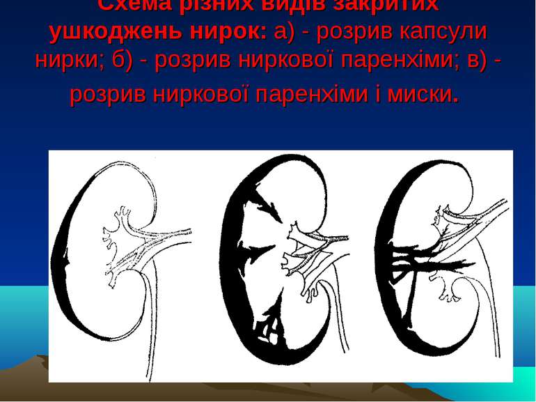 Схема різних видів закритих ушкоджень нирок: а) - розрив капсули нирки; б) - ...