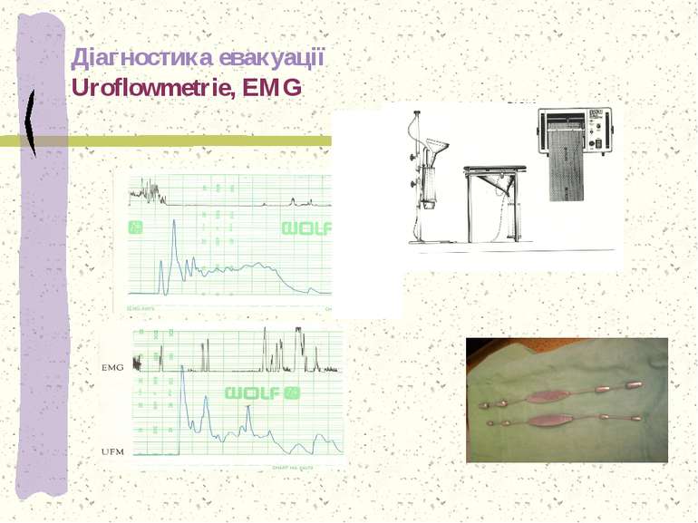 Діагностика евакуації Uroflowmetrie, EMG