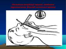 Методика інтубації трахеї: введення ларигноскопа. Вигляд голосової щілини