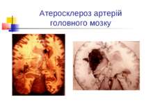 Атеросклероз артерій головного мозку