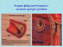 Розрив фіброзної бляшки і оклюзія артерії тромбом