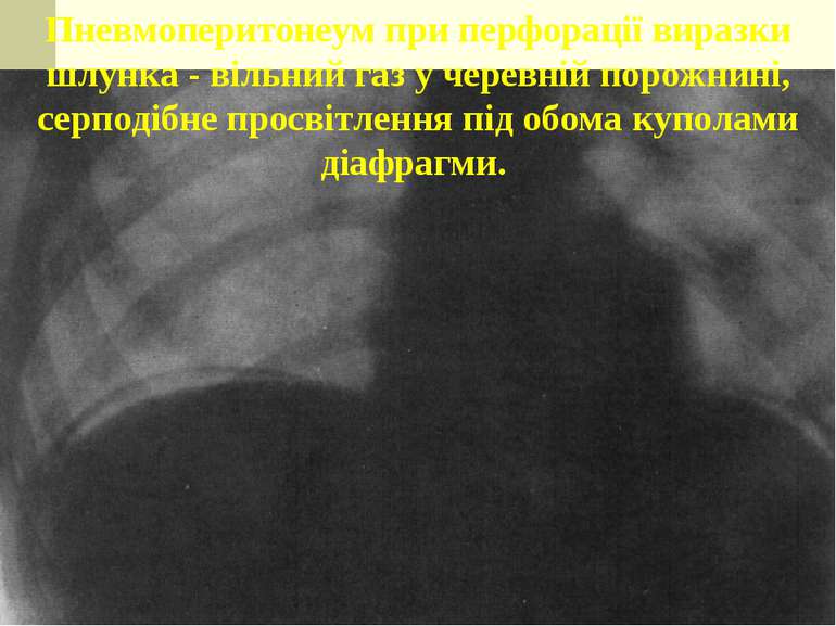 Пневмоперитонеум при перфорації виразки шлунка - вільний газ у черевній порож...