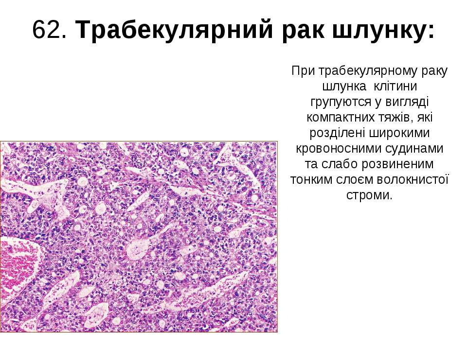 Солидная опухоль это. Трабекулярная аденокарцинома. Трабекулярное строение опухоли это. Трабекулярная структура опухоли. Аденокарцинома трабекулярные структуры.