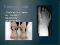 Полідактилія Домінантна генна патологія – наявність додаткових пальців