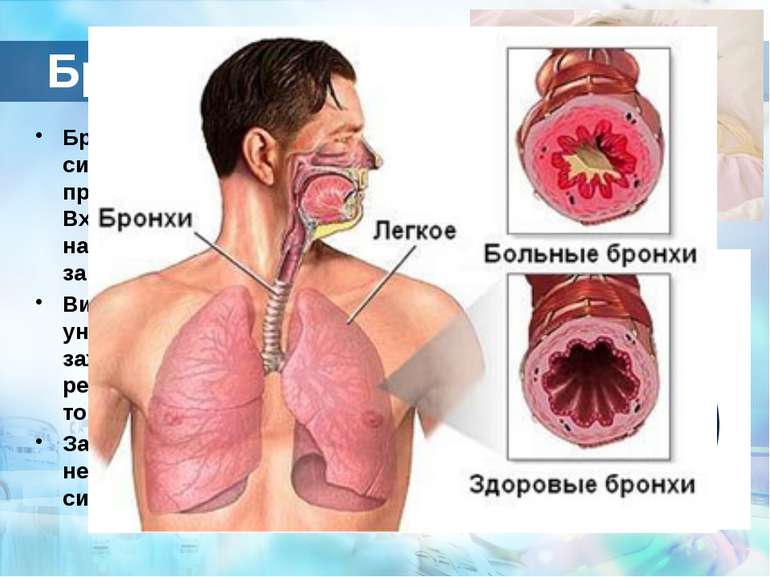 Бронхіт Бронхіт- захворювання дихальної системи , при якому в запальний проце...