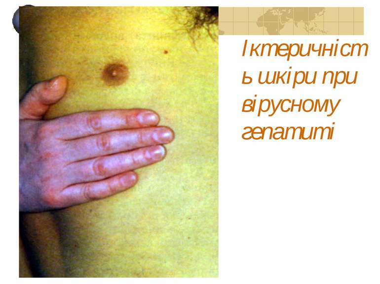 Іктеричність шкіри при вірусному гепатиті