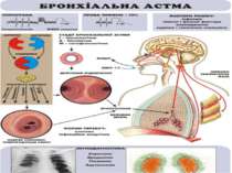 Схема патогенезу бронхіальної астми
