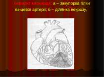 Інфаркт міокарда: а – закупорка гілки вінцевої артерії; б – ділянка некрозу.