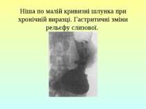 Ніша по малій кривизні шлунка при хронічній виразці. Гастритичні зміни рельєф...