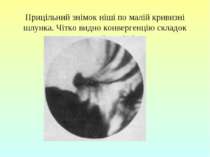 Прицільний знімок ніші по малій кривизні шлунка. Чітко видно конвергенцію скл...