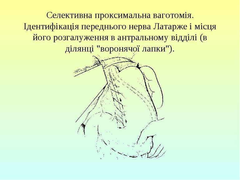 Селективна проксимальна ваготомія. Ідентифікація переднього нерва Латарже і м...