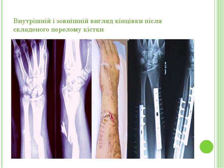 Внутрішній і зовнішній вигляд кінцівки після складеного перелому кістки