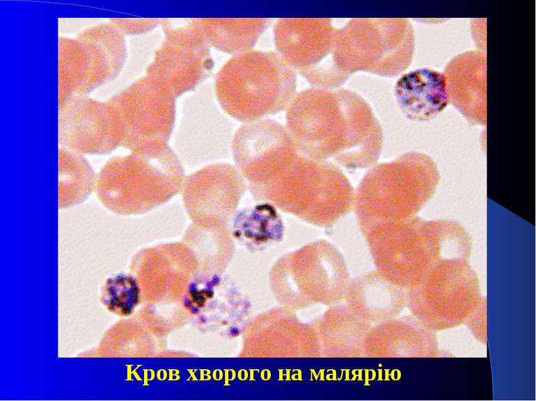 Кров хворого на малярію