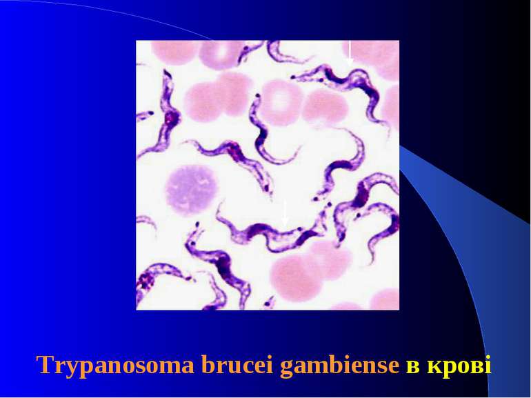 Trypanosoma brucei gambiense в крові