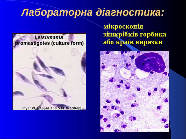 Лабораторна діагностика: мікроскопія зішкрібків горбика або країв виразки
