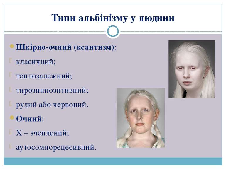 Типи альбінізму у людини Шкірно-очний (ксантизм): класичний; теплозалежний; т...