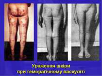 Ураження шкіри при геморагічному васкуліті