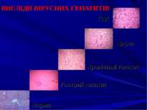 ВИСЛІДИ ВІРУСНИХ ГЕПАТИТІВ Норма Гострий гепатит Хронічний гепатит Цироз ГЦК