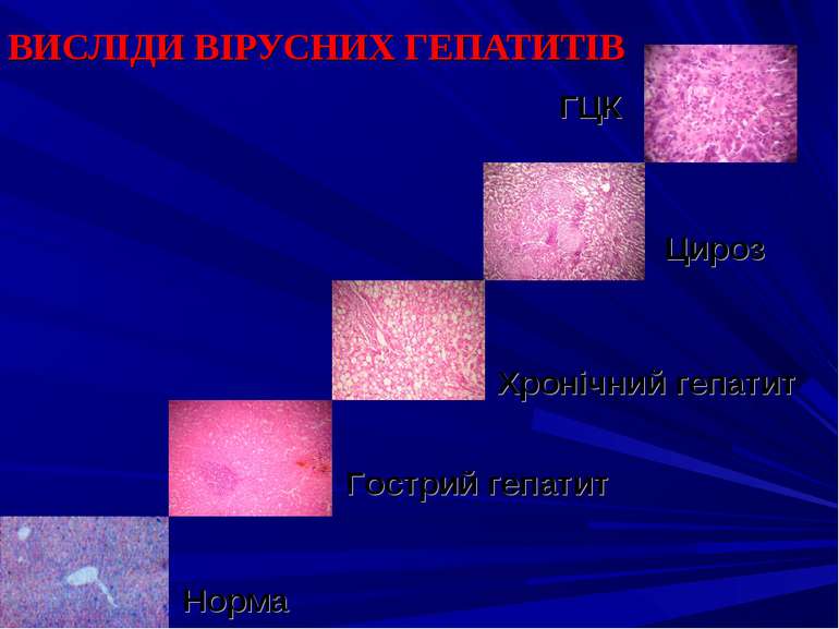 ВИСЛІДИ ВІРУСНИХ ГЕПАТИТІВ Норма Гострий гепатит Хронічний гепатит Цироз ГЦК