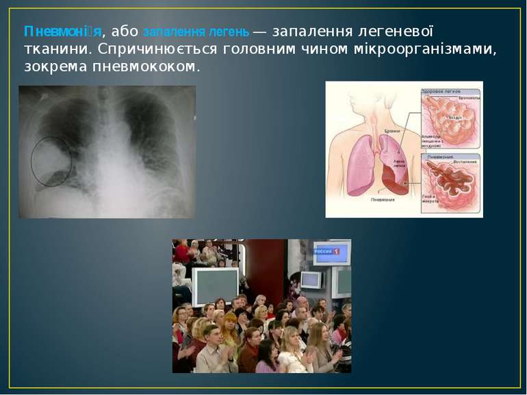 Пневмоні я, або запалення легень — запалення легеневої тканини. Спричинюється...