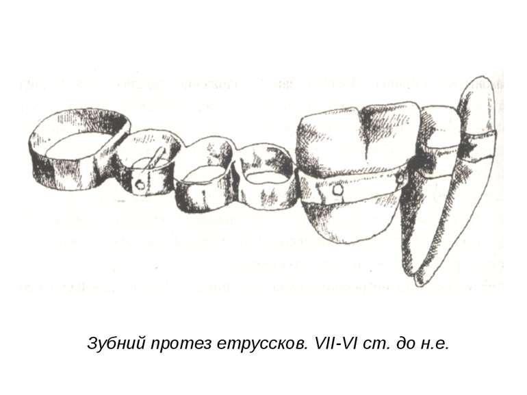Зубний протез етруссков. VII-VI ст. до н.е.