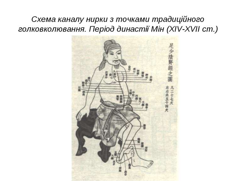 Схема каналу нирки з точками традиційного голковколювання. Період династії Мі...