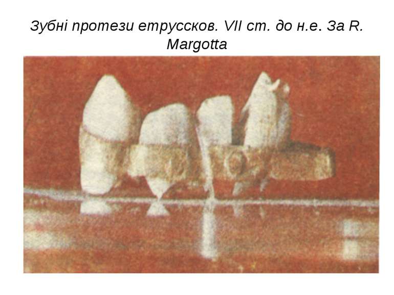 Зубні протези етруссков. VII ст. до н.е. За R. Margotta