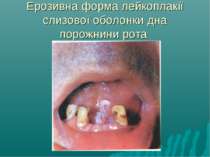 Ерозивна форма лейкоплакії слизової оболонки дна порожнини рота