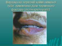 Виразка на червоній каймі нижньої губи, зумовлена дією термічного фактора (пі...