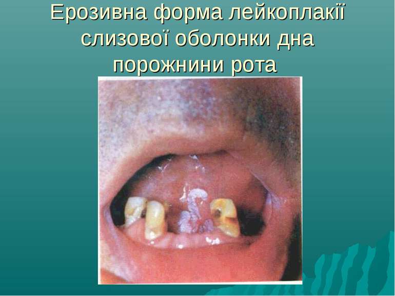 Ерозивна форма лейкоплакії слизової оболонки дна порожнини рота