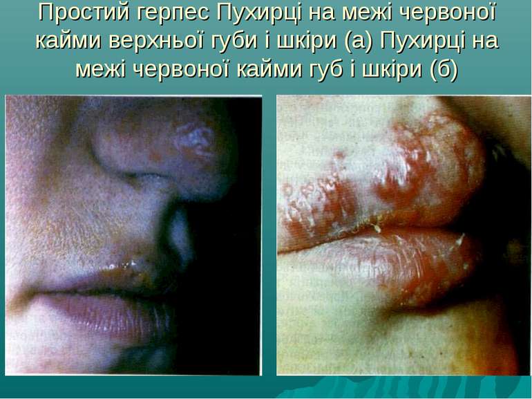 Простий герпес Пухирці на межі червоної кайми верхньої губи і шкіри (а) Пухир...