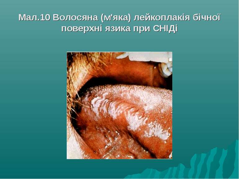 Мал.10 Волосяна (м'яка) лейкоплакія бічної поверхні язика при СНІДі