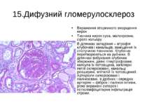 15.Дифузний гломерулосклероз Вираження вторинного зморщення нирок Тканина нир...