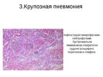 3.Крупозная пневмония Інфільтрація макрофагами, нейтрофілами. Зустрічаються п...