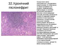32.Хронічний пієлонефрит Склеротичні зміни сполучаються з ексудативно-некроти...