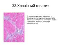 33.Хронічний гепатит У портальному тракті інфільтрат з Лімфоцитів, гістіоциті...